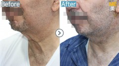 USA / Neck lifitng