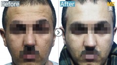 Malaysia / Face lifting (Forehead)
