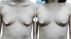 USA / fat graft