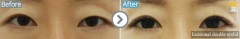 USA / Incisional double eyelid