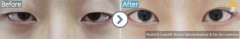 Korea /Medial ,Lateral& Bottom Epicanthoplasty & Eye line correction