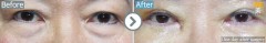 Singapore / Eyebrow skin lifting with Lower blepharoplasty