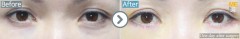 Singapore / Lower blepharoplasty