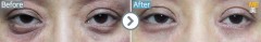 Taiwan / Lower blepharoplasty