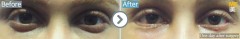 Arab Emirates / Lower blepharoplasty