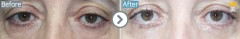 USA / Lower blepharoplasty