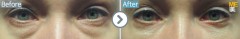 Russia / Lower blepharoplasty