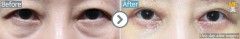 Singapore / Eyebrow skin lifting with Lower blepharoplasty