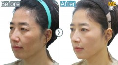 Canada/ endotine lifting with upper blephaloplasty, lower blepharoplasty, and eyebrow skin lifting