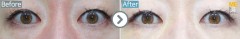 Singapore / Non- incision type (Reposition surgery of fats on lower eyelids