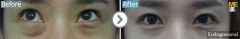 Usa / Eyebags Removal