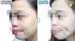 Singapore / Dimple (both side)