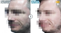 USA / Dimple (both side)