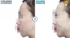 Thailand / Dimple (both side)