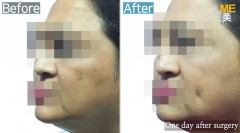 Singapore/ Dimple (both side)