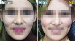 USA / Dimple (both side)