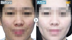 Singapore / Dimple (both side)