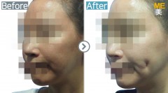 Taiwan / Dimple (both side)