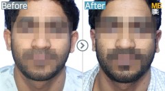 Pakistan / Otoplasty