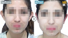 Singapore / Otoplasty