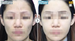 Singapore / Fat graft (Cheek)