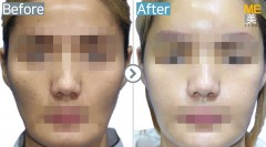 Singapore / Fat graft (Cheek)
