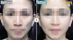 Korea / Fat graft (Cheek)