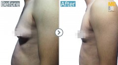 Singpaore/Gynecomastia
