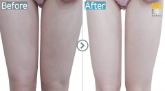 Singapore / Fat reduction (Mesotherapy on thighs)