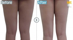 Singapore / Fat reduction (Mesotherapy on thighs)
