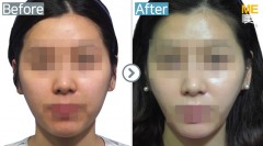 Korea / Accusculpt