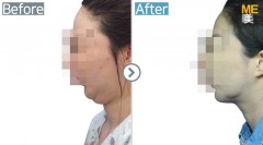 Korea / Accusculpt