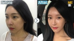 Korea / Anti-Wrinkle (Full Face youth filler)