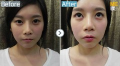 Korea / Anti-Wrinkle (Lip filler)