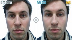 RUSSIA / Anti-Wrinkle (Under eye filler)