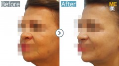 USA / Anti-Wrinkle (Nasolabial fold)