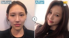 Korea / Anti-Wrinkle (Full Face youth filler)