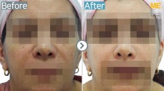 Singapore / Anti-Wrinkle (Nasolabial fold)