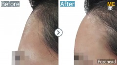 Singapore / Anti-Wrinkle (Forehead)