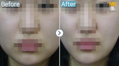 Singapore / Ultherapy