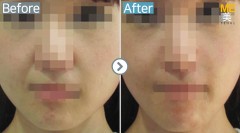 Singapore / Ultherapy