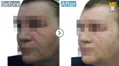 USA / Ultherapy