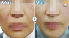 Singapore / Ultherapy