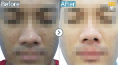 Singapore / Rejuran healer