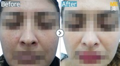 Singapore / Glutathione injection