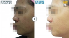 Singapore / Glutathione injection