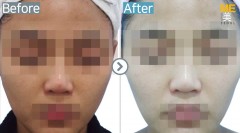 Singapore / Glutathione injection
