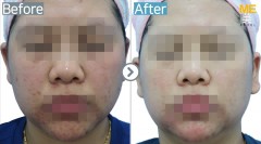 Singapore / Glutathione injection