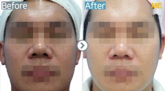 Singapore / Glutathione injection