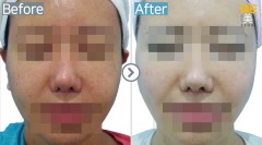 Singapore / Glutathione injection